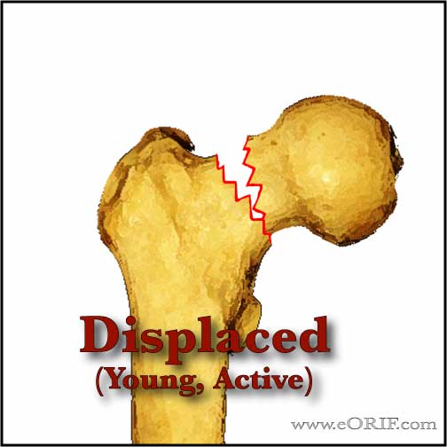 Displaced femoral neck fracture image