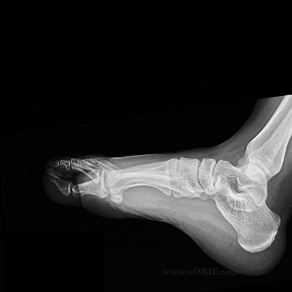 Foot lateral view xray