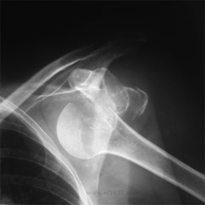 Greater tuberosity fracture xray