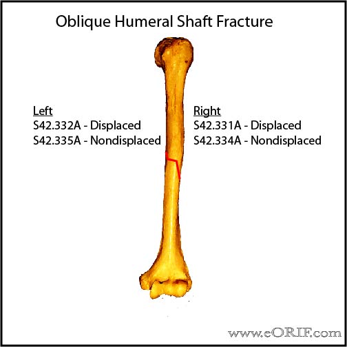 oblique humeral shaft fracture classification ICD-10