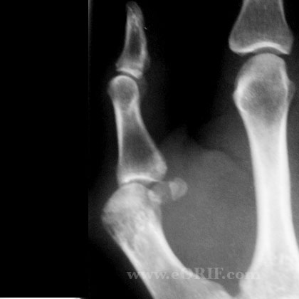 MCP arthritis lateral view xray