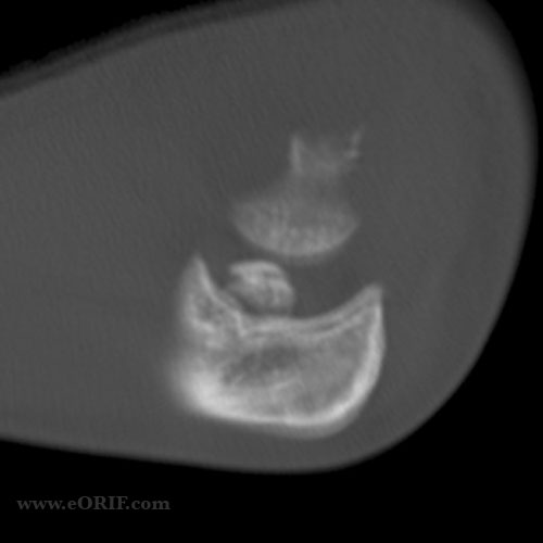 medial epicondyle fracture CT scane