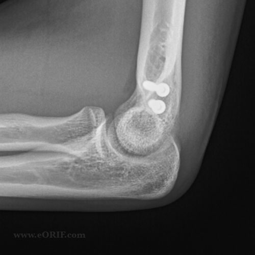 medial epicondyle fracture ORIF xray