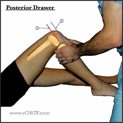 knee posterior drawer test
