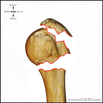 Type B2 proximal humerus fracture