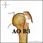 AO B3 proximal humerus fracture
