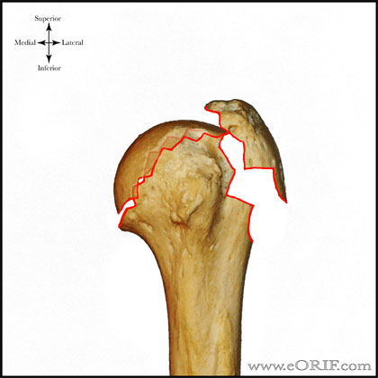 Type C1 proximal humerus fracture