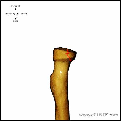 Type I radial head fracture image