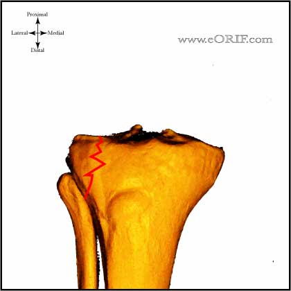 Type I Tibial Plateau Fracture image