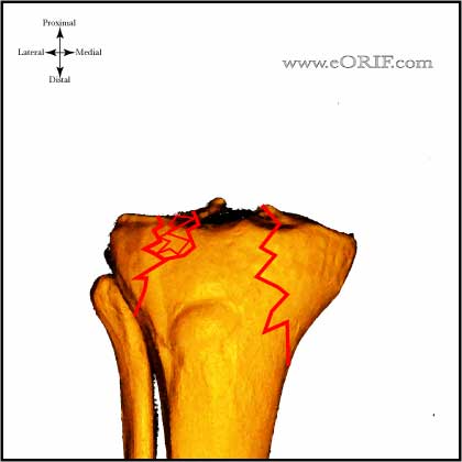Type V Tibial Plateau Fracture image