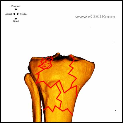 Type VI Tibial Plateau Fracture image