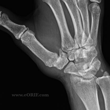 Thumb CMC osteoarthritis xray