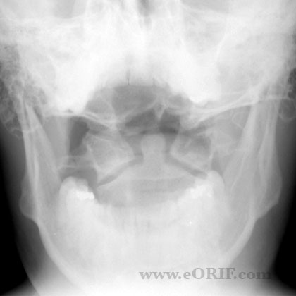 Cervical Spine Odontoid view 