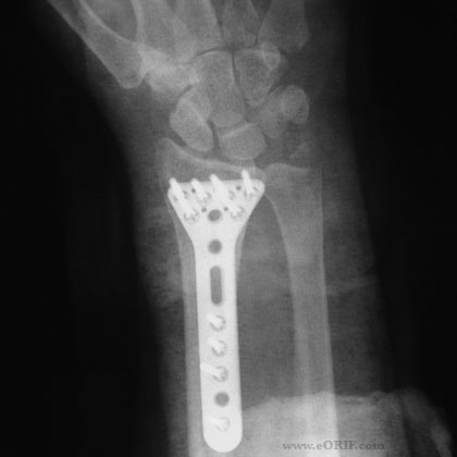 Distal radius fracture ORIF xray