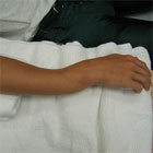 Forearm fracture picture