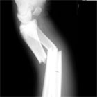 Radial and ulnar shaft fracture xray