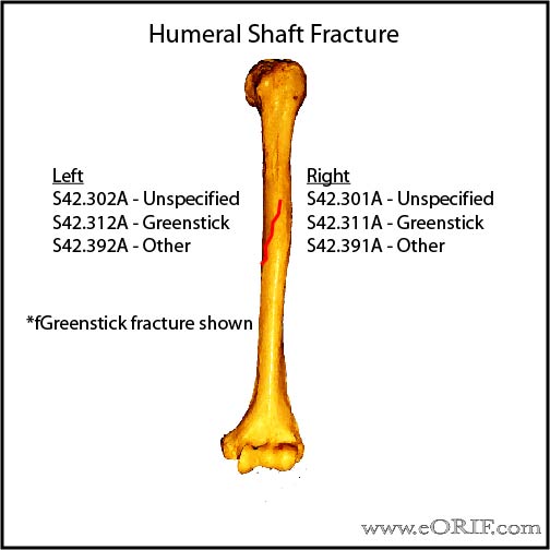 Humeral Shaft fracture ICD-10 classification