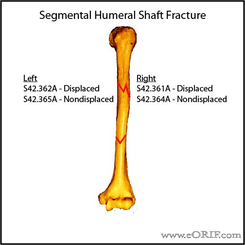 Segmental humeral shaft fracture ICD-10 classification
