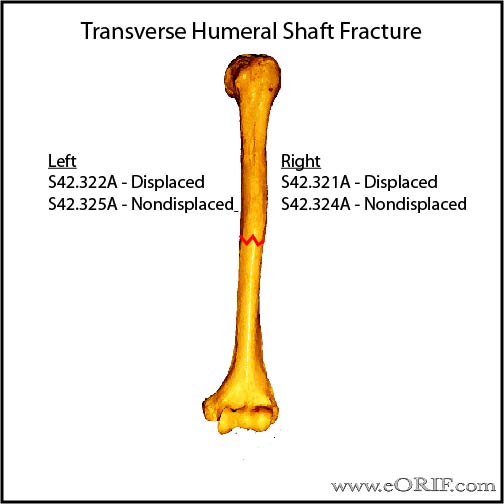 Transverse humeral shaft fracture icd-10 classification