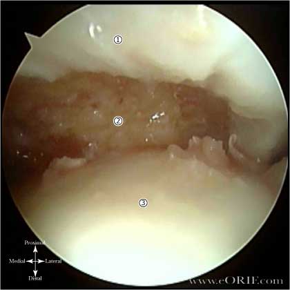 osteochondral patellar defect picture