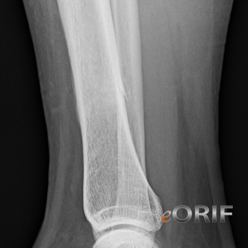 tibial shaft stress fracture xray