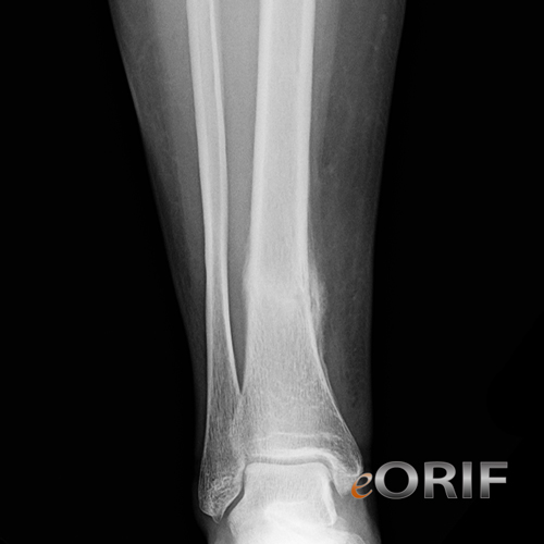 tibial shaft stress fracture xray