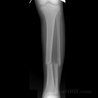 tibial shaft fracture nonunion xray