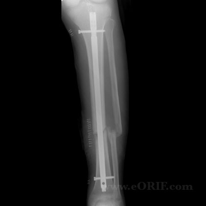 tibial shaft fracture nonunion im nail