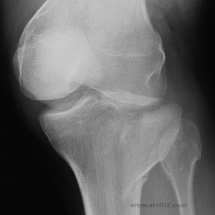 tibial plateau fracture xray