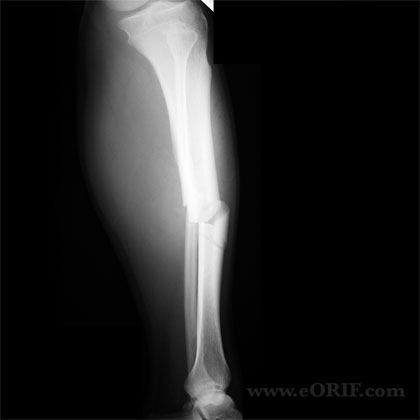 Tibial shaft fracture lateral view xray